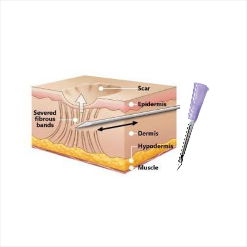 Subcision
